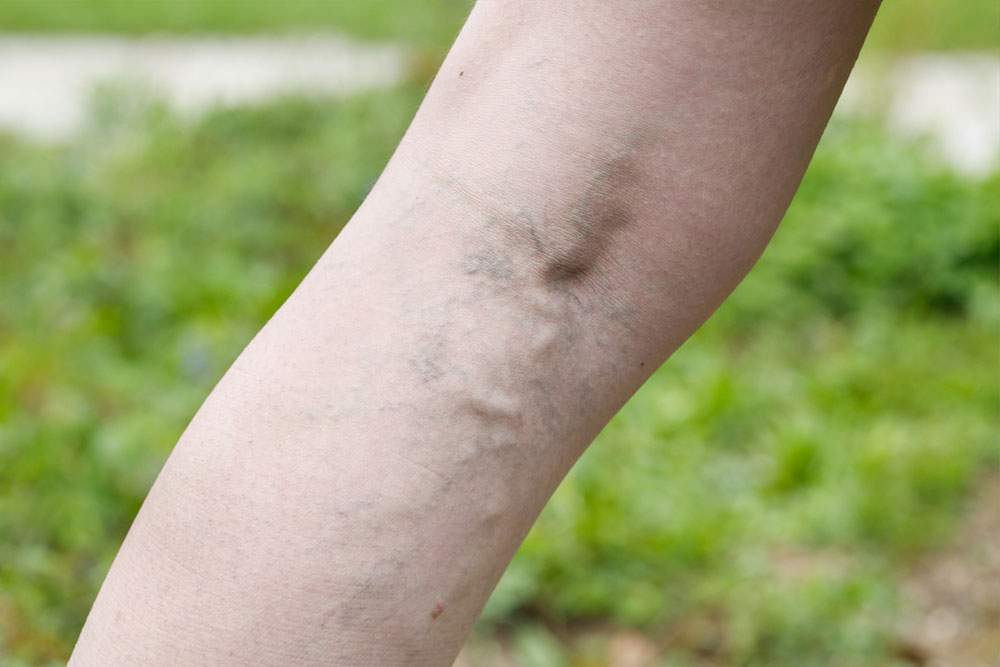 Common Symptoms and Treatments for Varicose Veins