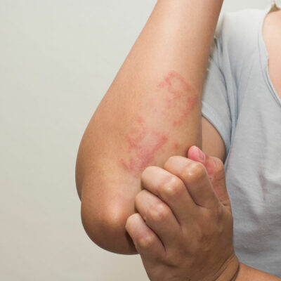 Common Types and Treatments of Eczematous Dermatitis