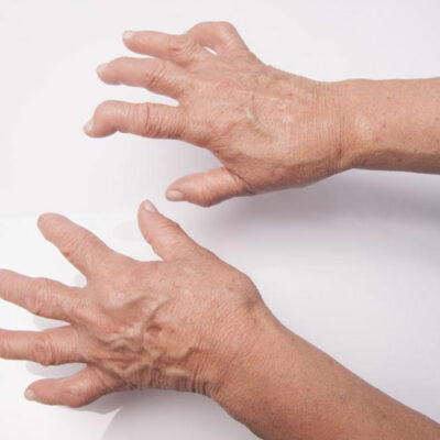 The Most Common Rheumatoid Arthritis Treatments