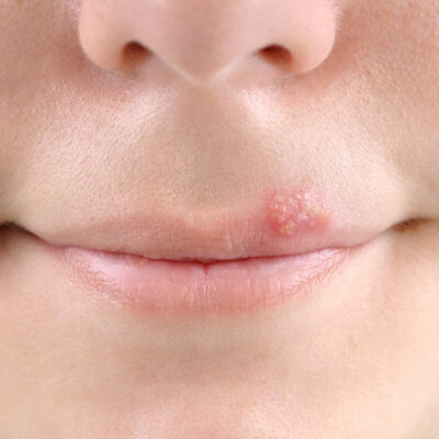 Tips to Treat Cold Sores Effectually